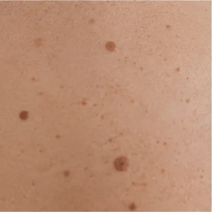 Ästhetische Laser-Anwendungsbereiche in Schwerin: Pigmentflecken, Couperose und Narben bei Dr. Dr. Ole Jung